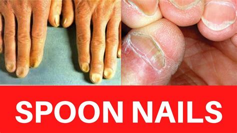 SPOON NAILS? : Koilonychia Causes, Treatment, Symptoms, Iron deficiency Anemia, Cure, Prevention ...