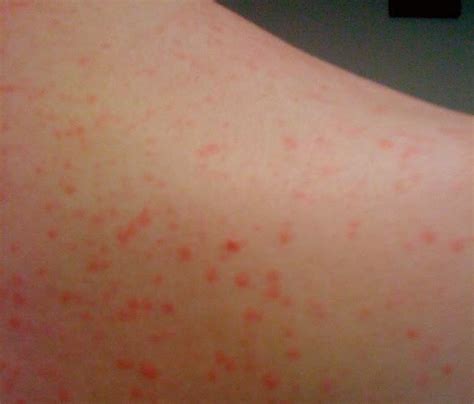 Cholinergic Urticaria - Treatment, Pictures, Symptoms, Causes