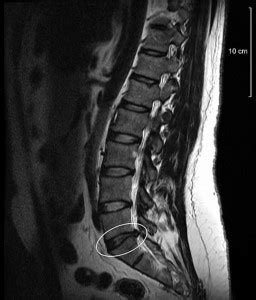 MRI Scan for Back Pain & Sciatica | Ann Arbor MI | Heilman Center