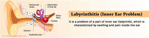 Labyrinthitis - Symptoms, Causes, Diagnosis, Treatment, Prognosis