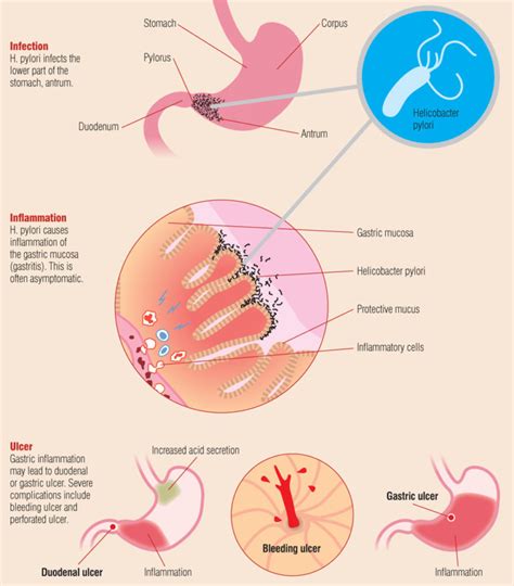 helicobacter-pylori-infection-inflammation-ulcer-diagram | Exeter Gut Clinic