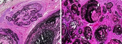 Compva: Typical histologic examples