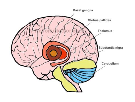 Right Basal Ganglia Hemorrhage