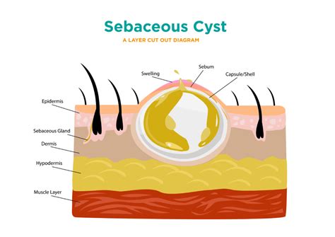 Sebaceous Cyst - Carpal Tunnel Surgery Clinic