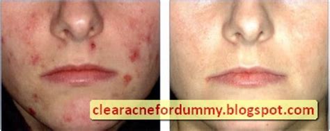 Salicylic Acid Acne - Does it work? | Clear Acne For Dummies