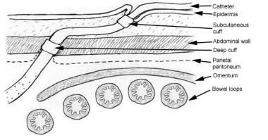 Peritoneal Dialysis Catheter Insertion