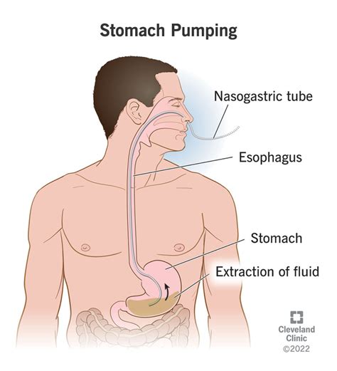 How Do They Pump Your Stomach for Alcohol Poisoning?