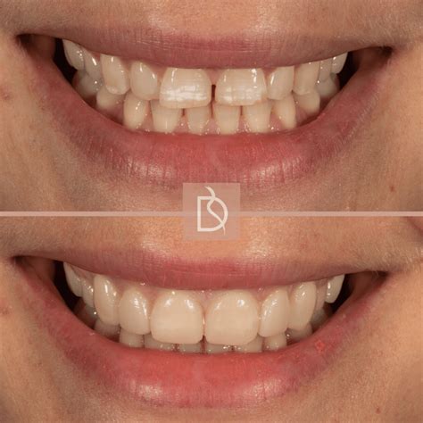 Composite Bonding Archives - Dental on The Banks