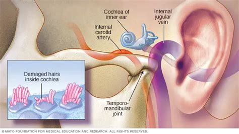 Causes and Treatments for Tinnitus (ringing in your ears) – The Natural ...