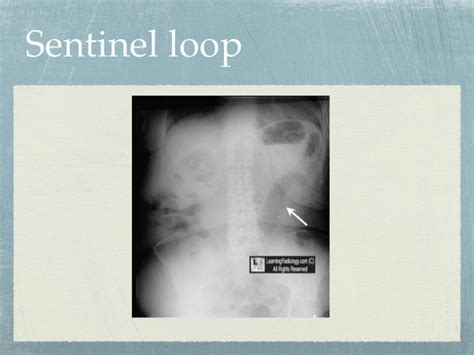 Acute pancreatitis