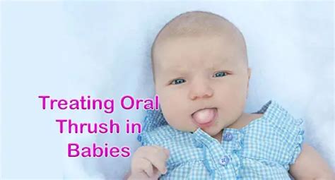 Thrush Treatment For Newborn