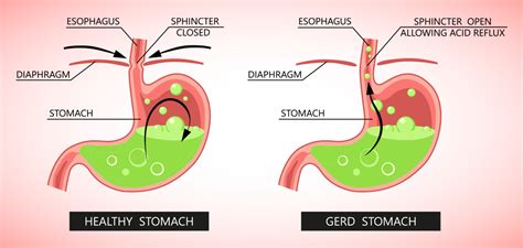 Gastro Esophageal Reflux: Treatment, Causes, Diagnosis, Treatment ...