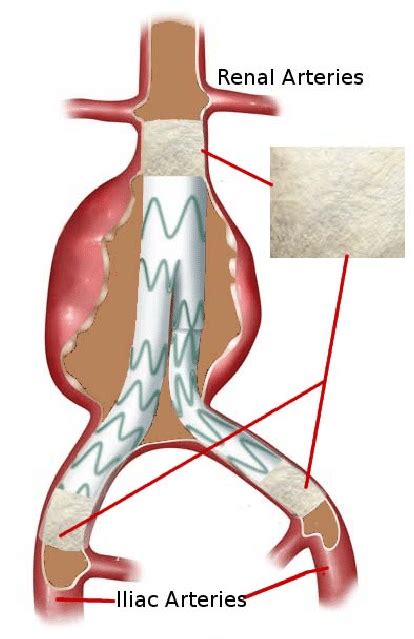 Possible solution for optimisation and stabilisation of the stent graft ...