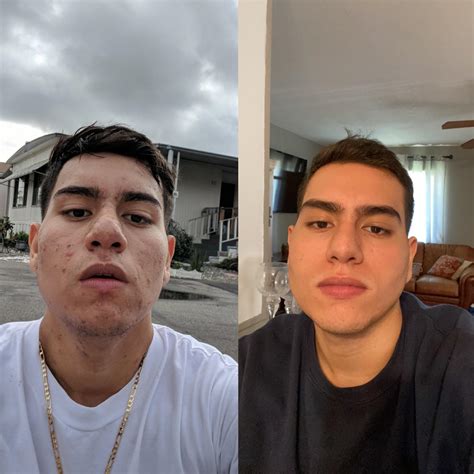 Before and after Accutane!! : r/Accutane