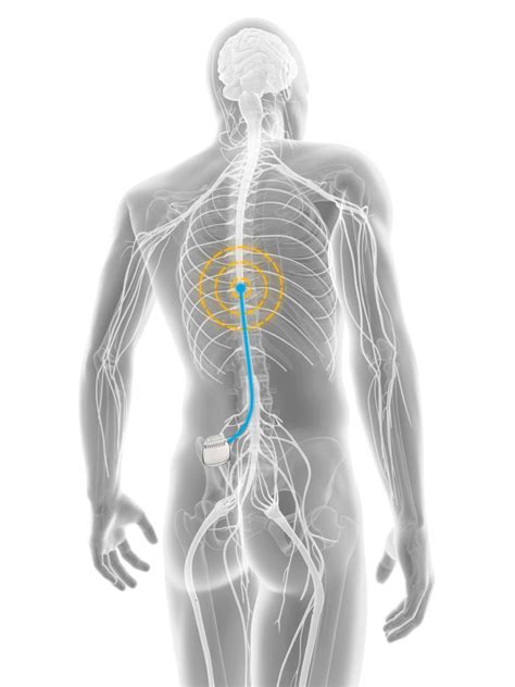 Spinal Cord Stimulation | Treatments | Twin Cities Pain Clinic