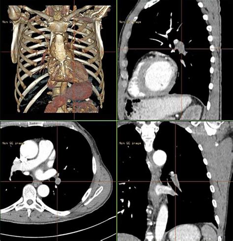 What Is A Ct Scan With Contrast For Chest