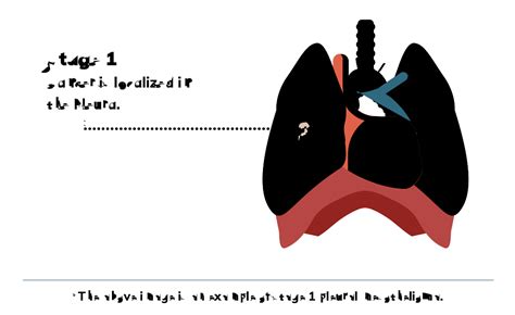 4 Stages of Mesothelioma | Symptoms & Treatment by Stage