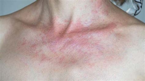 Your Rash Might Be a Sun Allergy