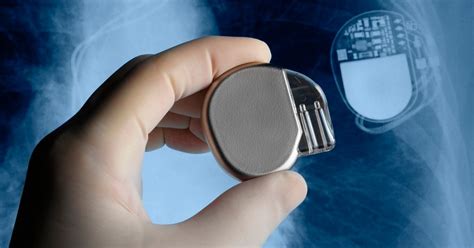 Pacemaker Battery Replacement: The Best Options and The Cost to Replace ...