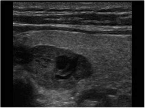 Head and Neck | 4.2 Parathyroid glands : Case 4.2.1 Parathyroids | Ultrasound Cases