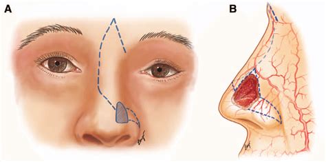 a, Frontal view of an additional myocutaneous rotation flap from the... | Download Scientific ...