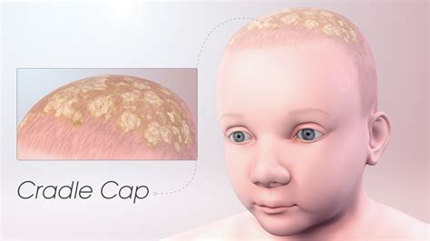 Cradle Cap: Symptoms, Causes, and Treatment - Scientific Animations