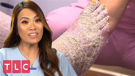 Dr. Lee Meets a Man Covered in Dry Scaly Skin | Dr. Pimple Popper - YouTube