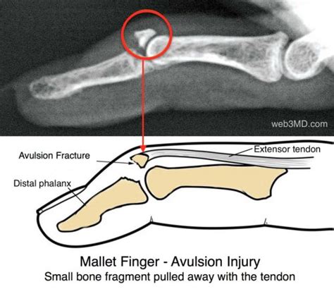 Mallet Finger Fort Worth Hand Therapy Center - OSMI