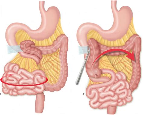 Cecal volvulus causes, symptoms, diagnosis, treatment & prognosis