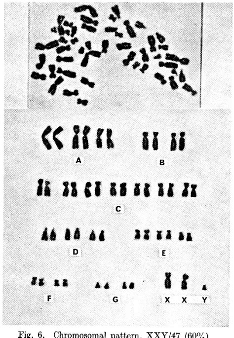 Figure 6 from A case of hypogonadotropic hypogonadism with an XY/XXY sex chromosome mosaicism ...