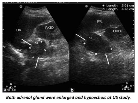 Presentation1.pptx, ultrasound examination of the adrenal glands and