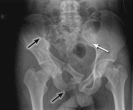 Pelvic Fracture X Ray