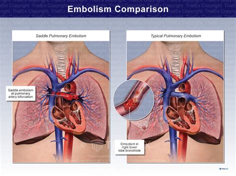 Pulmonary Embolism Comparison - TrialQuest Inc.