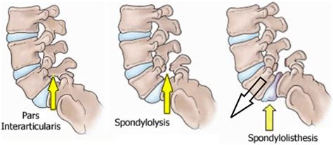 Spondylolisthesis causes, symptoms, diagnosis, grades, treatment ...