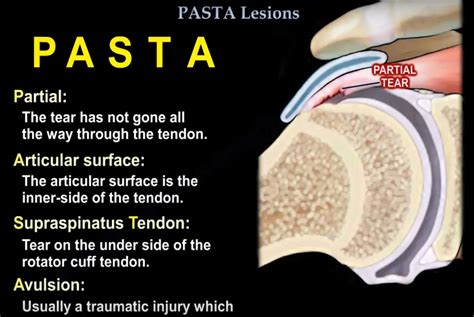 PASTA of the Shoulder — OrthopaedicPrinciples.com