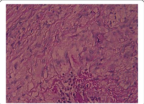 Globulomaxillary Cyst Histology