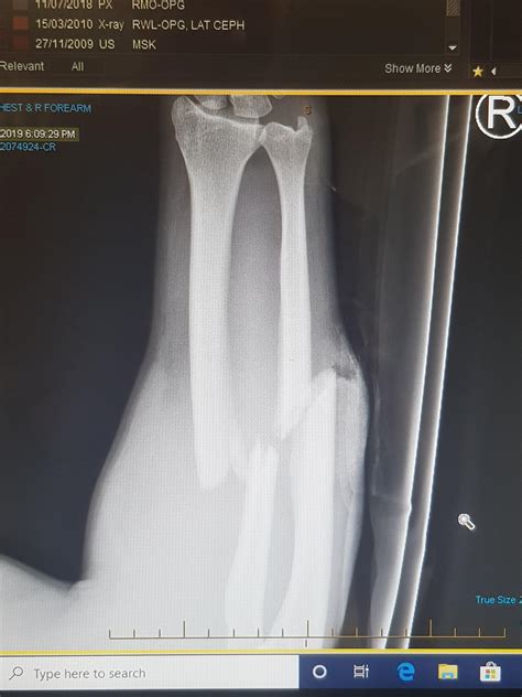 Compound Fracture. I'm out lads : r/Neverbrokeabone