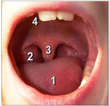 Causes of Swollen Uvula (Throat) - Symptoms, Treatment, Remedies ...