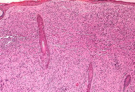 Pathology Outlines - Leprosy