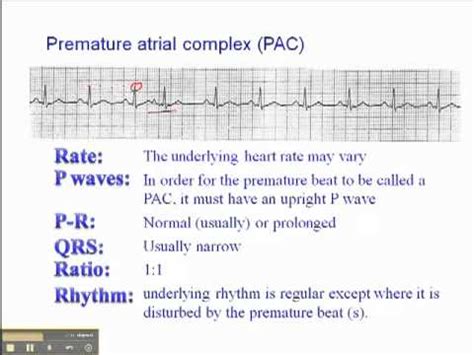 What Is The Treatment For Atrial Fibrillation