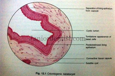 Histologic or Microscopic Features of Odontogenic Keratocyst