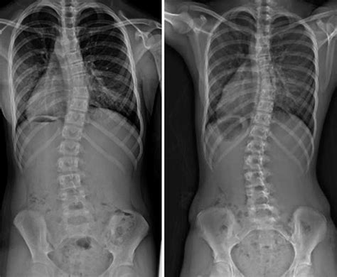 Scoliosis X Ray Before And After