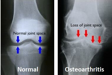 Osteophytes X Ray