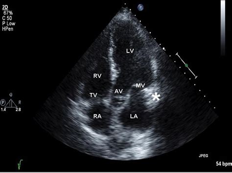 Two dimensional Echocardiogram – Apical long axis -5 chamber view ...