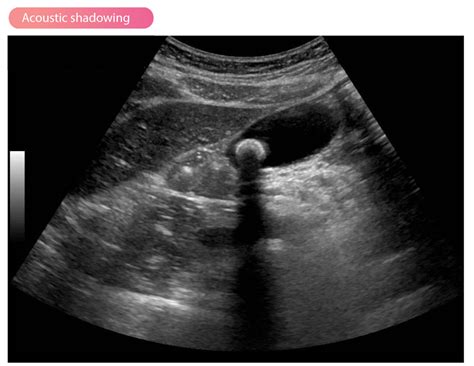 Artifacts in ultrasound imaging – The Cardiovascular