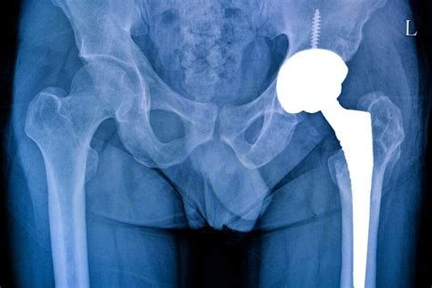 Types of Hip Replacements - Dr. Gregory Hicken