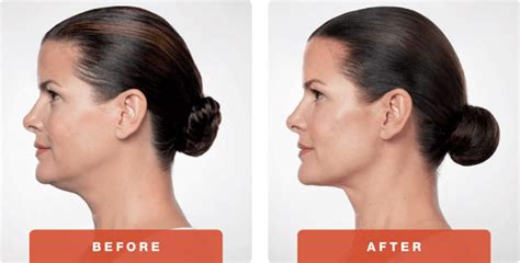 Austin Kybella Injectables | Double Chin Treatment by Dr. Bittar