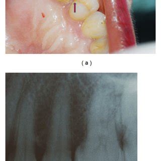 (a) Faint fracture line can be detected on distal marginal ridge... | Download Scientific Diagram