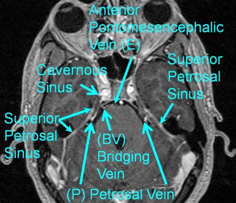 V_bridging_vein_MRI_Petrosal_homolog.png (760×655) | Sinusitis, Mri, Anatomy