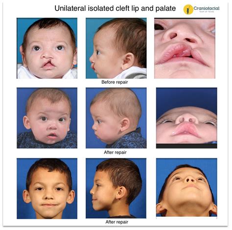 Cleft Lip And Palate Pdf